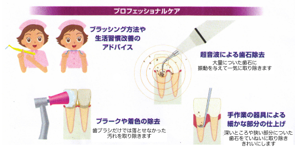 PMTC (プロが器具を用いて行う歯のクリーニング）